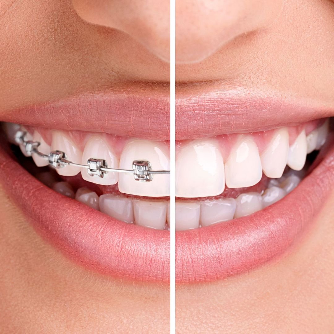 progressdental braces&alignerservice